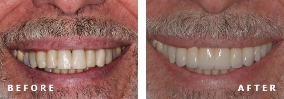 Smile image after treatment and before treatment