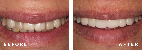 Before and After by Dentalogic